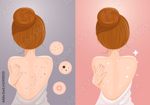 Acne caused on the back