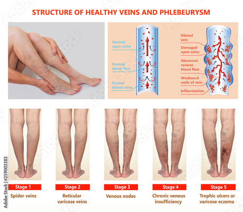 Thrombophlebitis. Deep Vein Thrombosis. Varicose veins