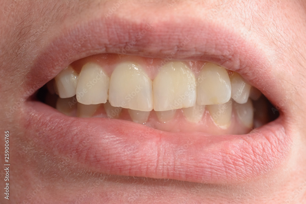 Obraz premium A young woman shows her crooked teeth that needs medical help in close-ups