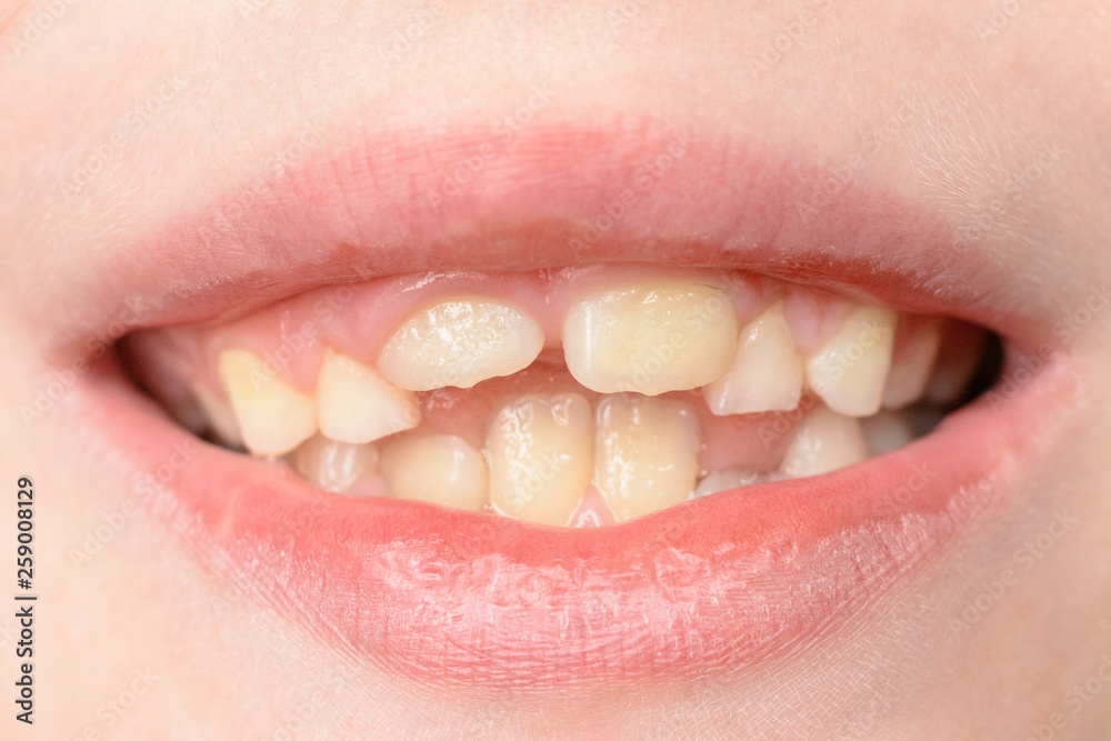Close-up of a small boy with curved teeth smiling Close-up of a small boy with curved teeth smiling