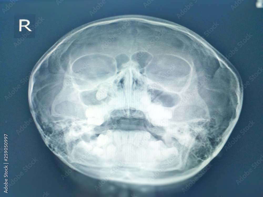 Paranasal sinuses x-ray finding Tooth in right maxillary sinus.No sinusitis. No bony destruction or mass. Paranasal sinuses x-ray finding Tooth in right maxillary sinus.No sinusitis. No bony destruction or mass.