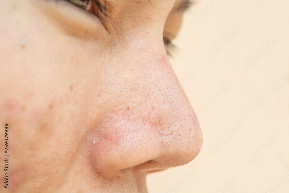 Obraz premium Acne scars and pores. In the nose Black spots, wrinkles and skin problems