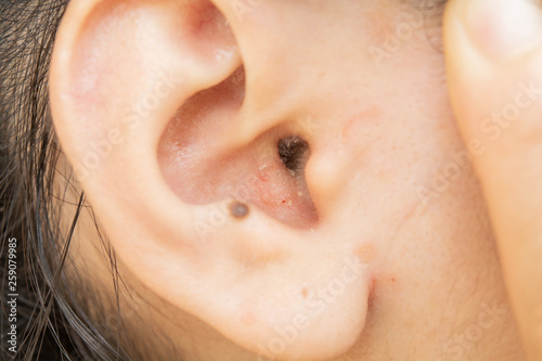 Dry skin disease in the ear