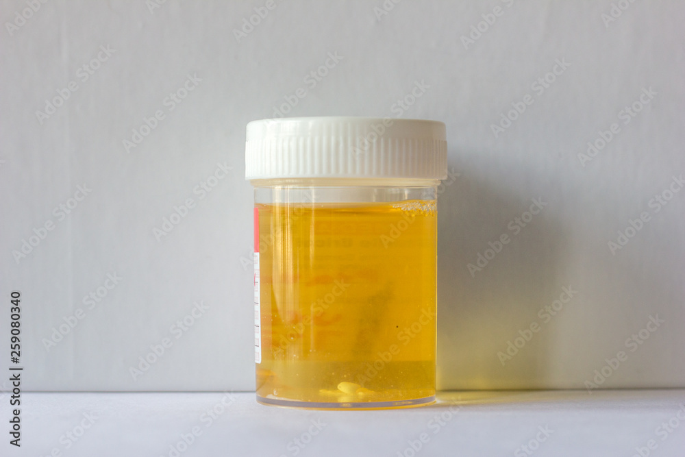 urine sample collected in a plastic container for urine culture and protein test isolated on a white background. urine sample collected in a plastic container for urine culture and protein test isolated on a white background.