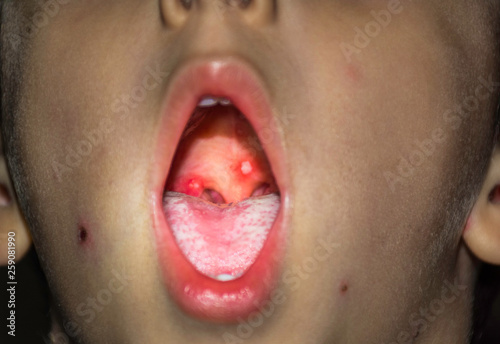 Varicella or Chicken Pox Virus on Childs Palate photo