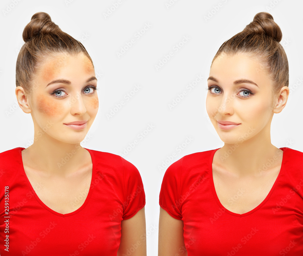 Dark spots, freckles,hyperpigmentation(melasma or chloasma) Dark spots, freckles,hyperpigmentation(melasma or chloasma)