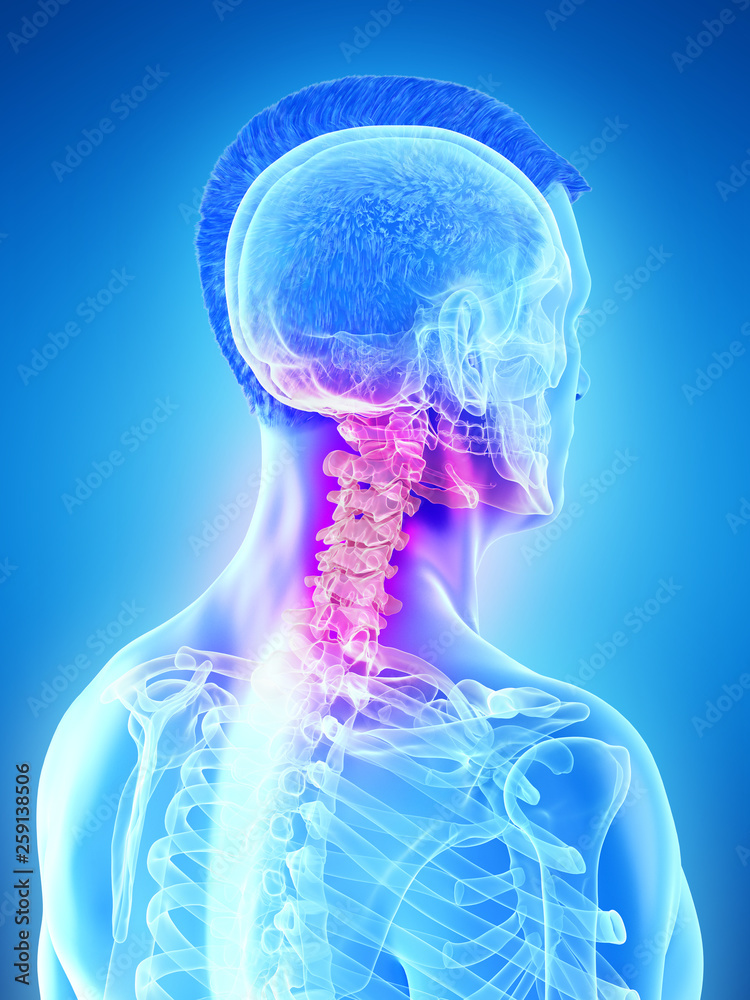 3d rendered medically accurate illustration of a mans painful neck 3d rendered medically accurate illustration of a mans painful neck