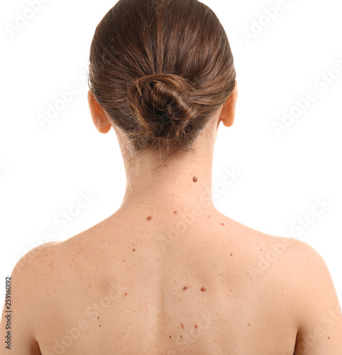 Young woman with moles on white background