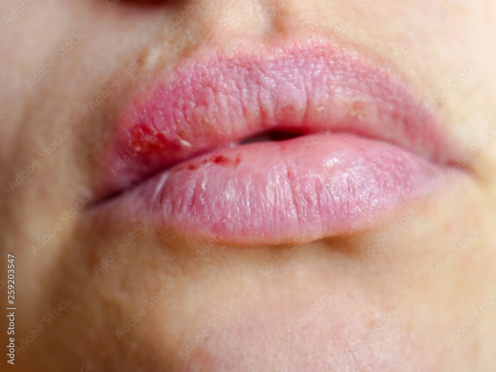 Beautiful female lips cracked from frost, wind, lack of vitamins. Sore
