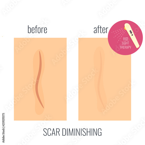 Scar revomal session treatment. Before and after