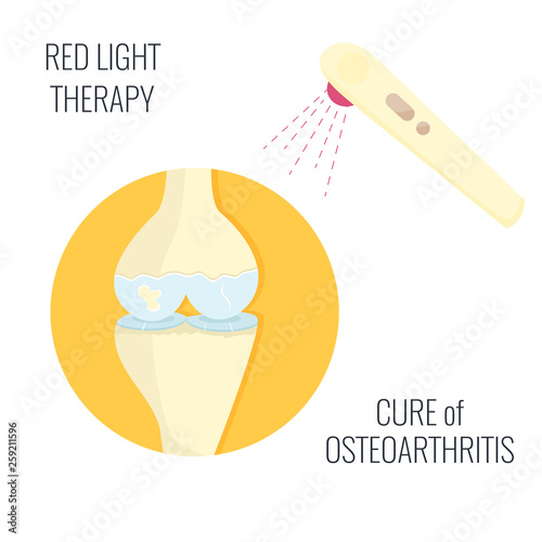 Osteoarthritis illustration. Red light therapy