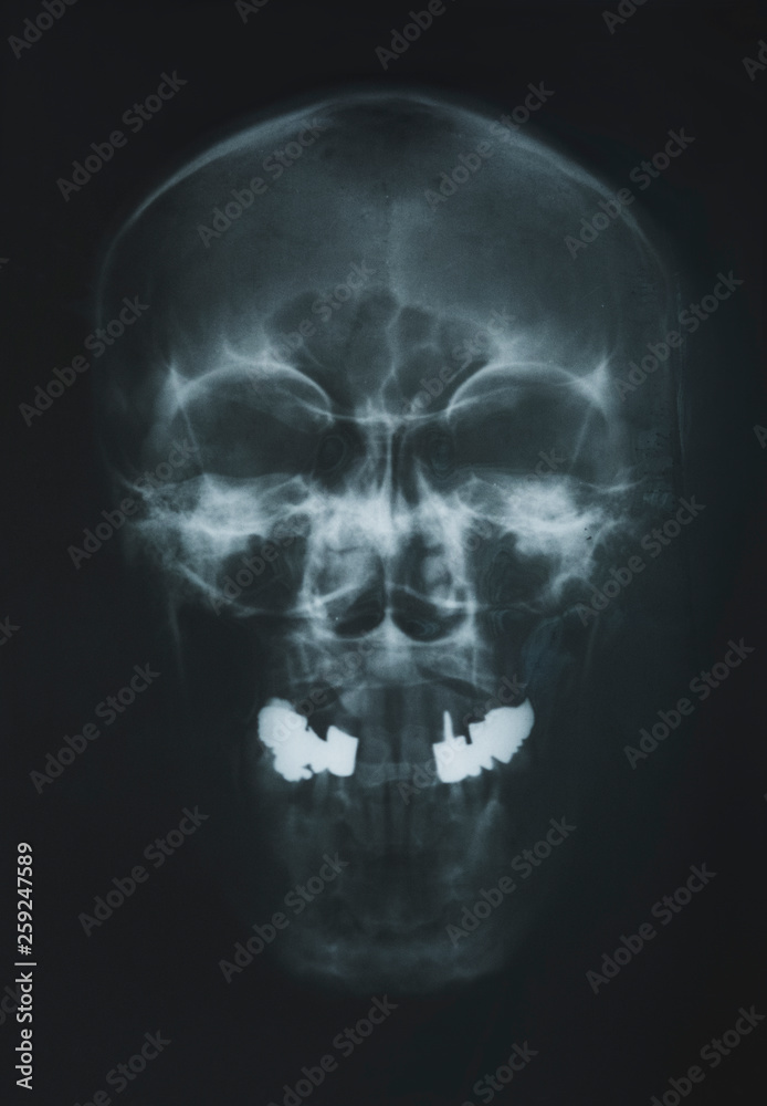 x-ray of the scull x-ray of the scull