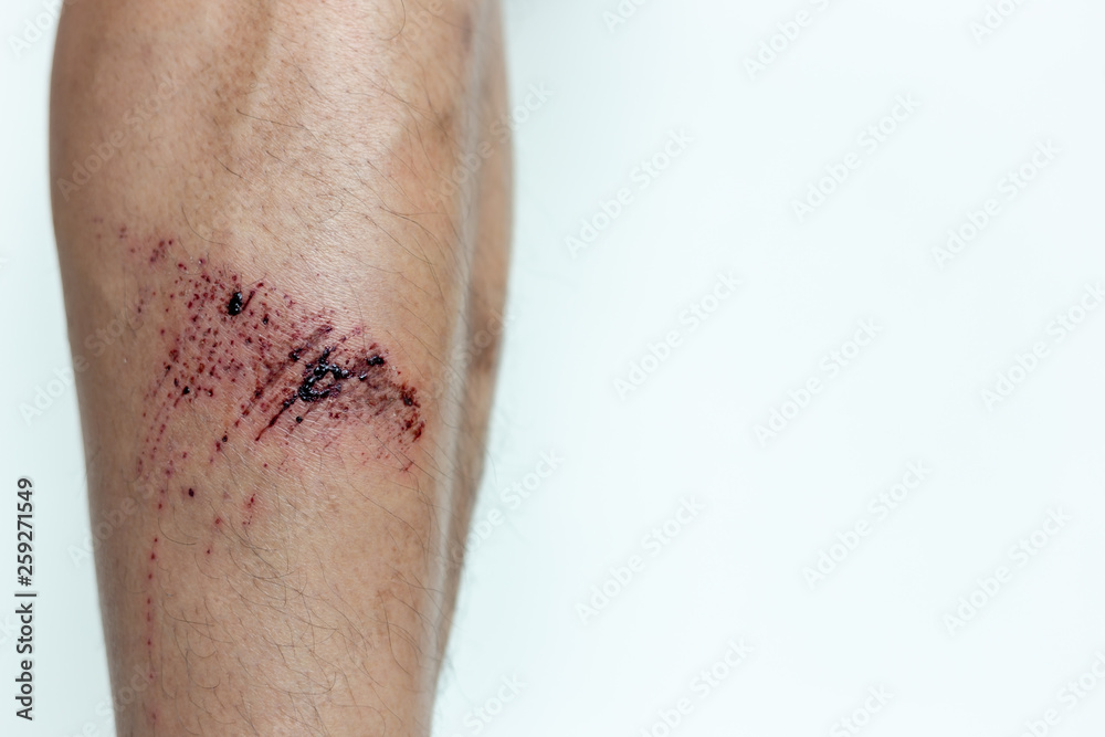 The wound form scabs. The wound happen during young man playing footbal and fall down on the footbal field. He get injured at his shin. It is big wound and abrasions. copy space The wound form scabs. The wound happen during young man playing footbal and fall down on the footbal field. He get injured at his shin. It is big wound and abrasions. copy space