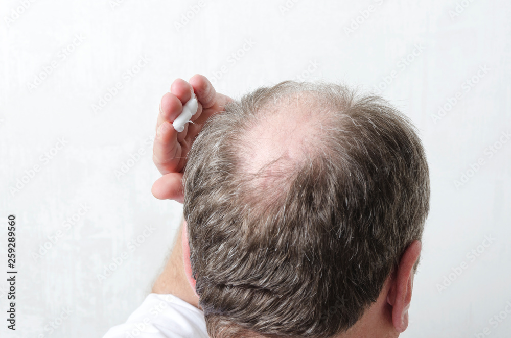 Man applying special cream for hair growth.Concept of beauty procedure for hair care Man applying special cream for hair growth.Concept of beauty procedure for hair care