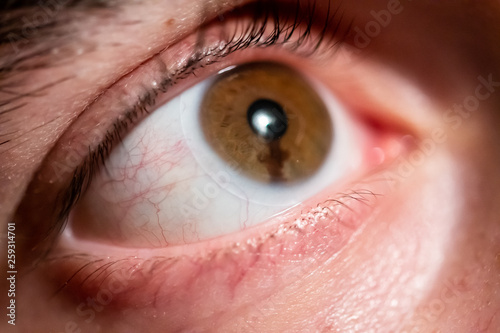 Eye freckle on iris that wears lens