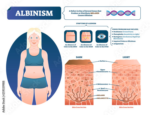 Albinism vector illustration. Labeled medical melanin pigment loss scheme.