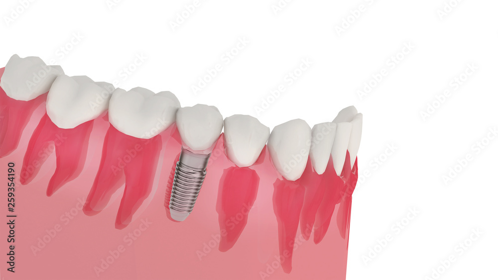 dental implant and natural teeth, Concept image of replacement tooth