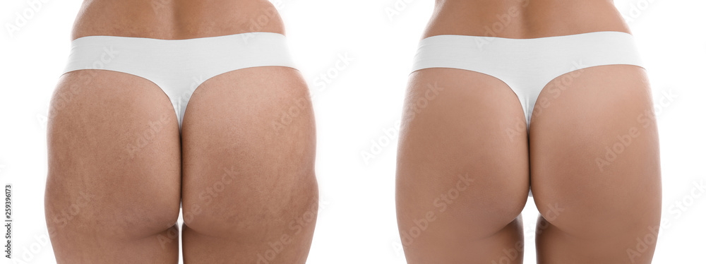 Woman before and after plastic operation on white background, closeup. Body care concept - obrazy, fototapety, plakaty 