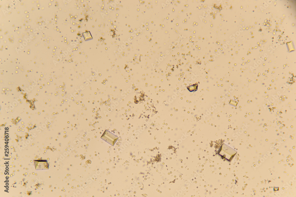 Urine crystals, red blood cells and leukocytes at the microscope. Urinary tract disease in cat
