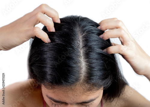 women head with dandruff Caused by the problem of dirty. Or caused by skin disease or Seborrheic Dermatitis. It has white scaly and it will cause itch.