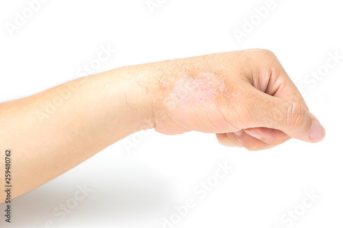 Men's hands are scratched because of itchy rashes caused by dermatitis. isolated on white background and clipping path.