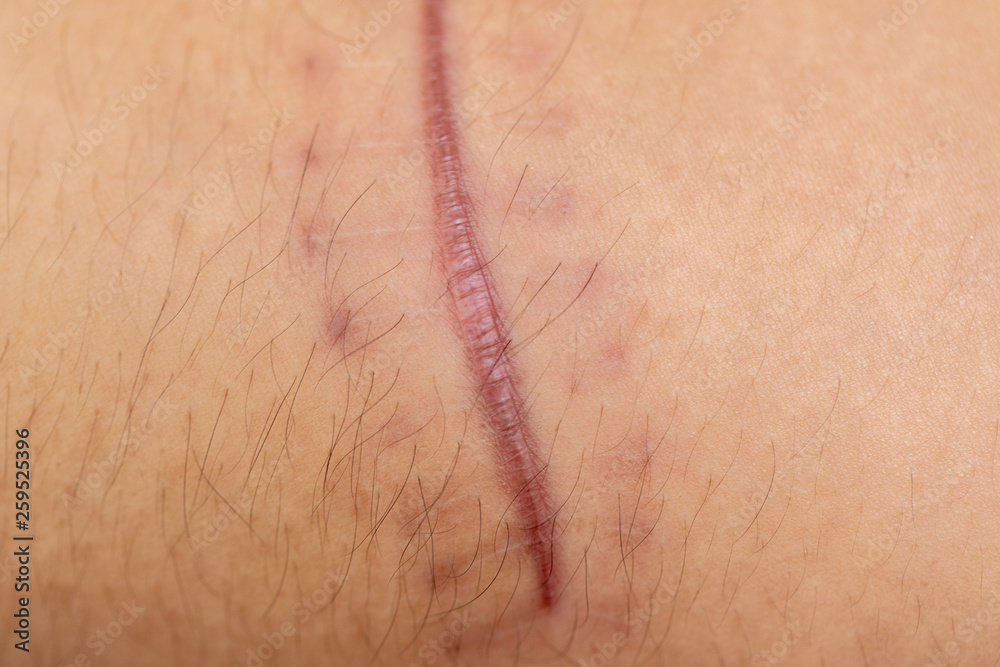 Fototapeta premium A scar is an area of fibrous tissue that replaces normal skin after an injury on skin.