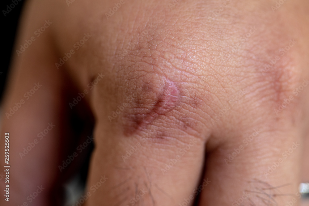 A scar is an area of fibrous tissue that replaces normal skin after an injury on skin. A scar is an area of fibrous tissue that replaces normal skin after an injury on skin.