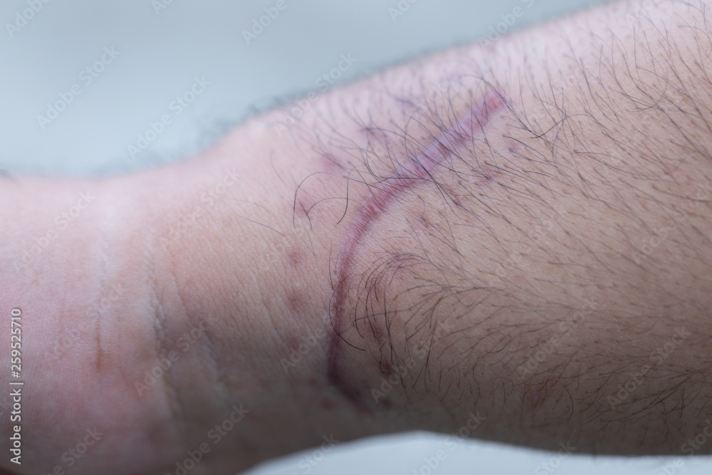 A scar is an area of fibrous tissue that replaces normal skin after an injury on skin. A scar is an area of fibrous tissue that replaces normal skin after an injury on skin.