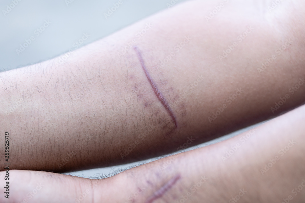 A scar is an area of fibrous tissue that replaces normal skin after an injury on skin. A scar is an area of fibrous tissue that replaces normal skin after an injury on skin.