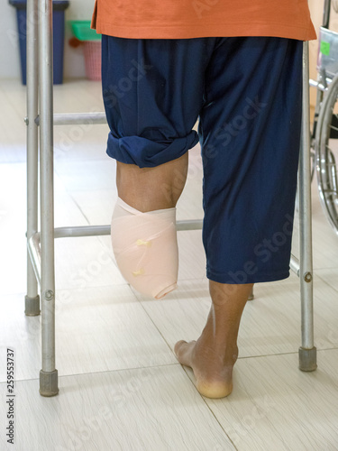 left leg amputee cause by Diabetic foot syndrome walking with walker and show stump with bandaging