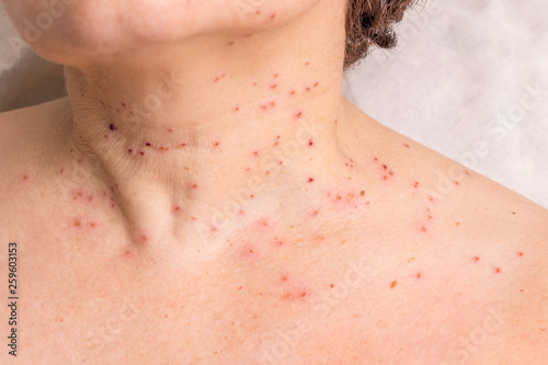 Obraz na plátně Traces of removal of papillomas on the neck of a woman_