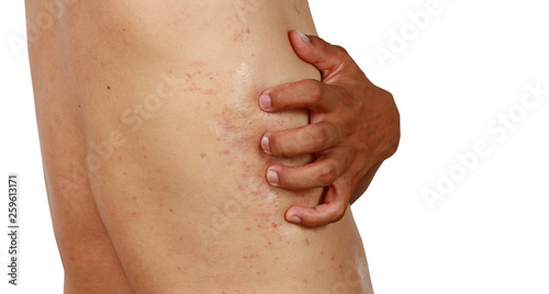 A man scratch rash  Closeup man scratching his itchy back with allergy rash