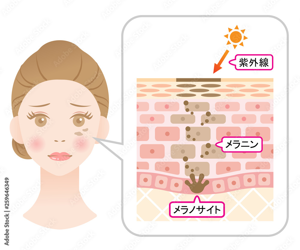 しみの構造 女性の顔と肌の断面図 Stock Vector Adobe Stock