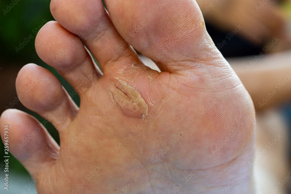 Fototapeta premium Woman's heel break and peeling, Dermatitis of foot, Green garden background, Close up and macro shot, Selective focus, Asian Body skin part, Healthcare concept