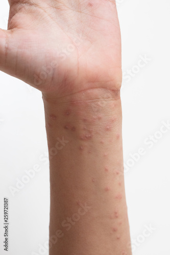 Closeup view of an itchy rash on the wrist of a toddler