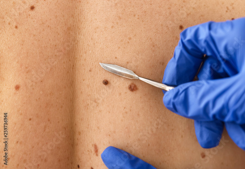 Stampa su tela Doctor with lancet going to remove mole from patient's skin, closeup