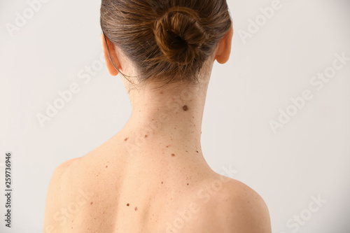 Young woman with moles on light background