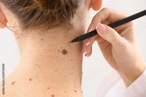 Foto Dermatologist applying marks onto patient's skin before moles removal, closeup
