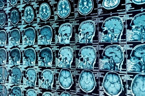 MRI scan of the brain