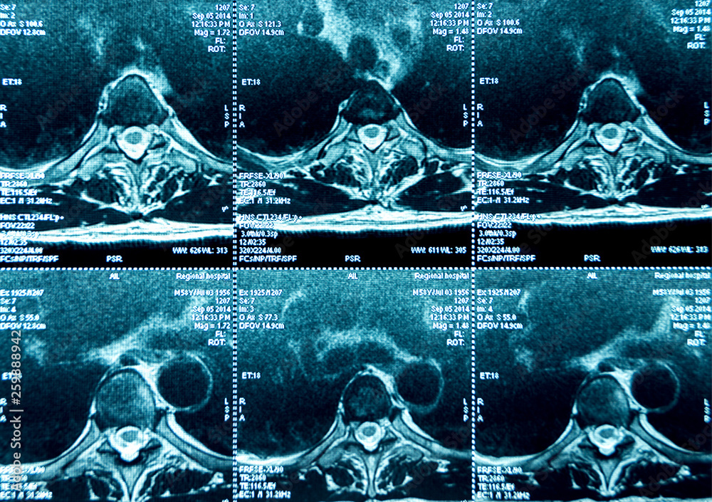 MRI of the thoracic spine Stock Photo | Adobe Stock