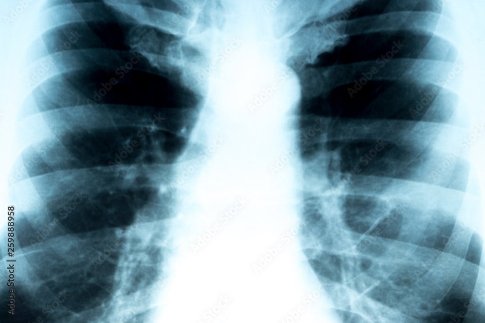 X-ray of the chest X-ray of the chest