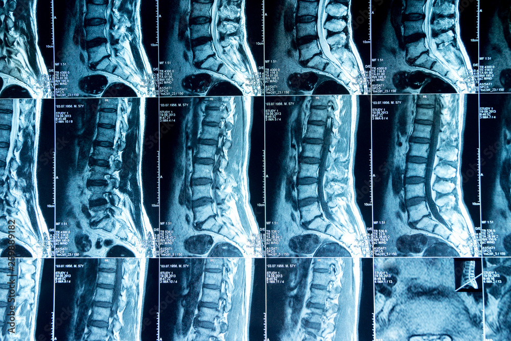 MRI scans of the lumbosacral spine Stock Photo | Adobe Stock