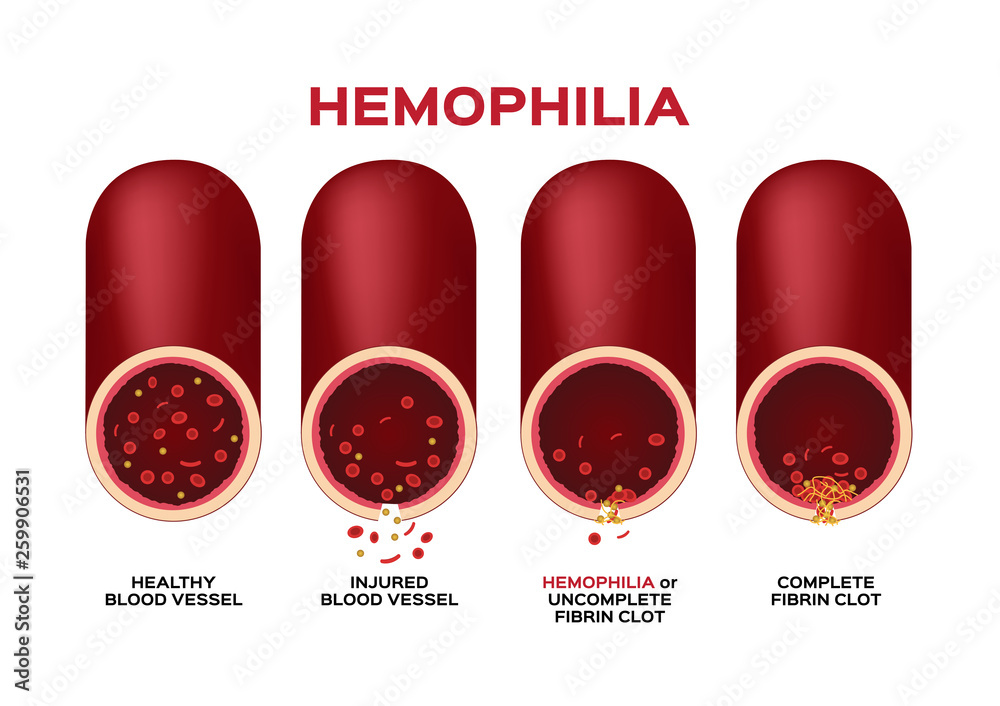 hemophilia or haemophilia and blood vessel vector / bleeding / wound