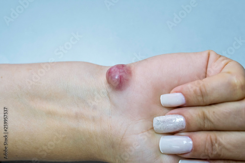 Ganglion Cyst on female right hand