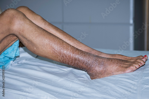 Ichthyosis on woman legs