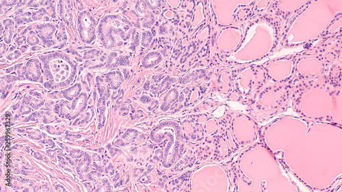 Thyroid gland cancer awareness: Microscopic image of papillary thyroid carcinoma, follicular variant (left), with invasion into benign follicles or normal thyroid tissue (right). photo