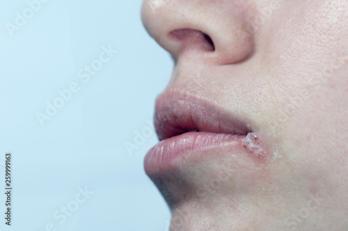 girl with herpes on her lips macro