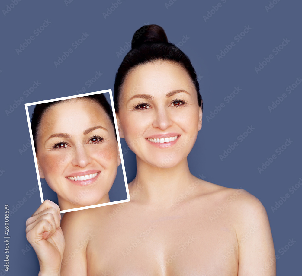 Dark spots, freckles,hyperpigmentation(melasma or chloasma) Dark spots, freckles,hyperpigmentation(melasma or chloasma)
