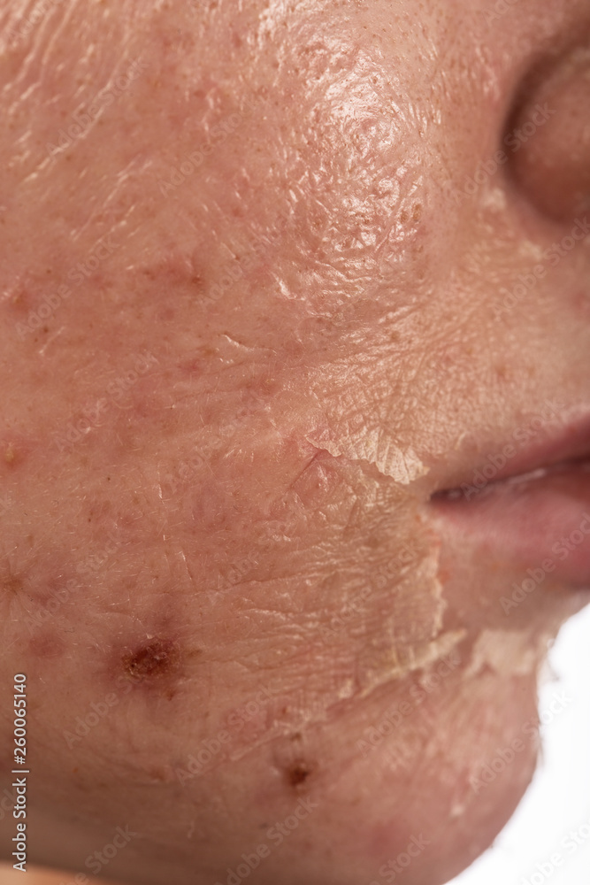 skin after peeling skin after peeling