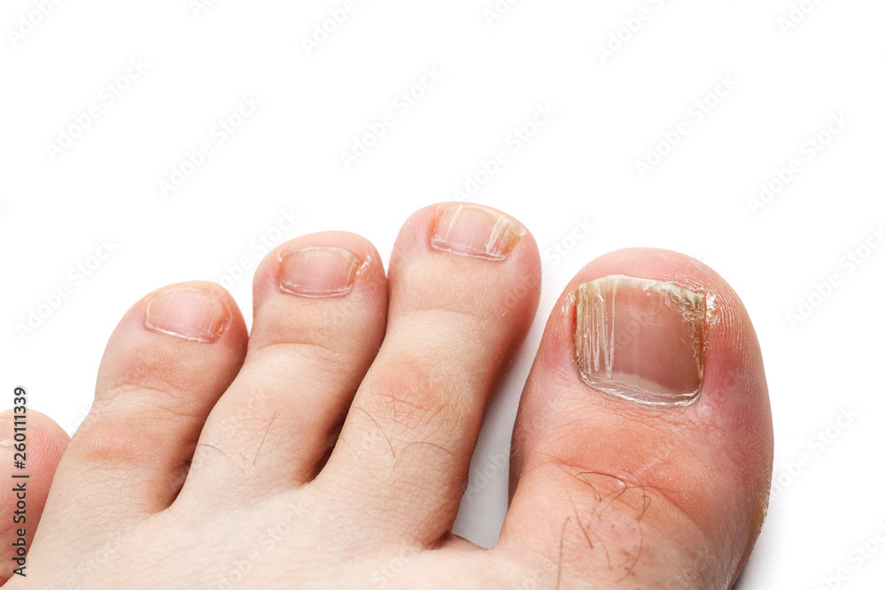 Cracked nails of the toes isolated on white, closeup shot
